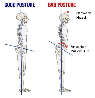 Chiropractic Apex NC Good Posture Versus Bad Posture