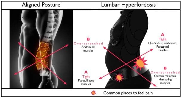 Chiropractic Apex NC Lower Cross Syndrome Diagram